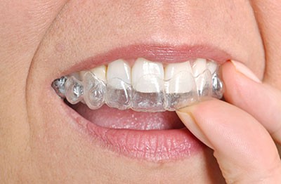 Invisalign Orthodontics
